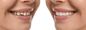 dental veneers